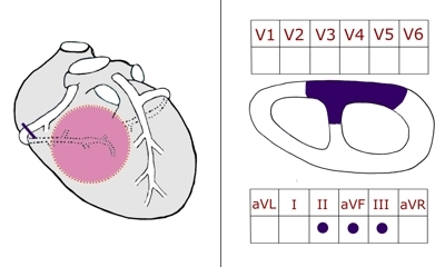 Vorderwandinfarkt ekg